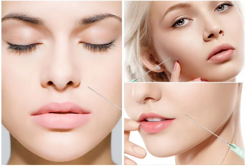 Revolax Hyaluronic Acid Fillers For lip augmentation injections and superficial wrinkle removal