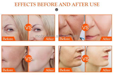 Revolax Hyaluronic Acid Fillers For lip augmentation injections and superficial wrinkle removal