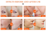 Dermalax HA Hyaluronic Acid  Dermal Fillers 1 ml For lip augmentation injections and superficial wrinkle removal